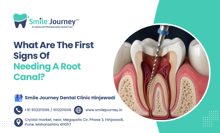 What Are The First Signs Of Needing A Root Canal?