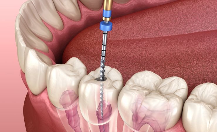 Five Benefits Of Root Canal Treatment That Will Amaze You