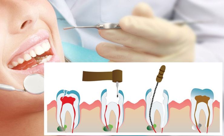 Save Your Natural Tooth with Root Canal Treatment: Everything You Need to Know