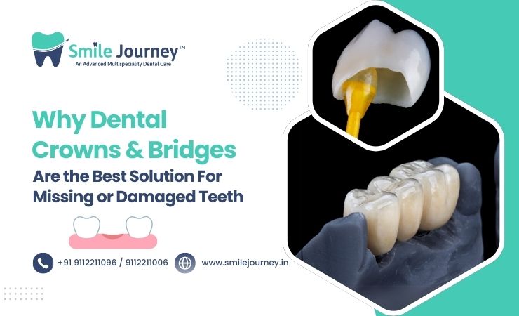 Why Dental Crowns and Bridges Are the Best Solution for Missing or Damaged Teeth